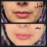 سرم پر کننده و سفت کننده صورت وایپر مناسب انواع پوست